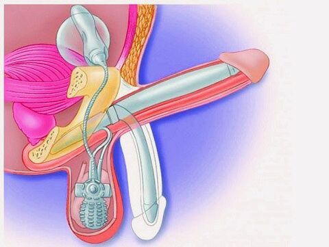 Penis enlargement with a penile prosthesis