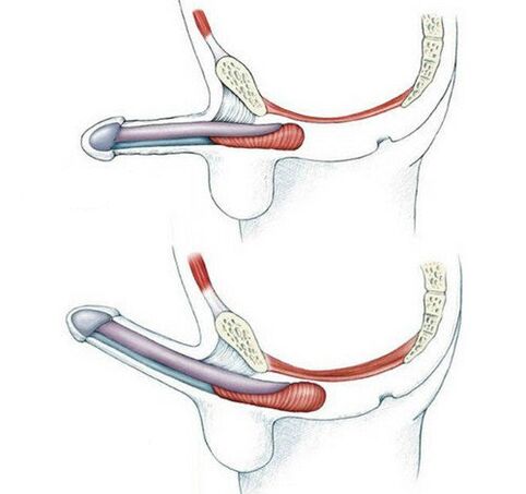 Penis without the pubococcygeus muscle and then trained